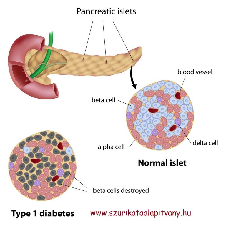 1-es típus cukorbetegség cukorbetegség a kezdeti szakaszban